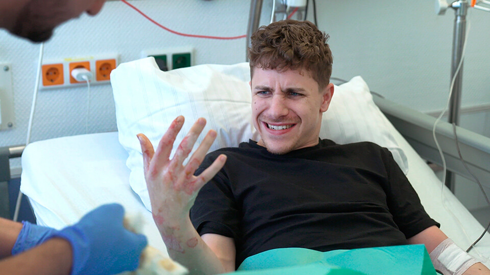 Alexander hat sich beim Frittieren eine schwere Brandverletzung zugezogen.